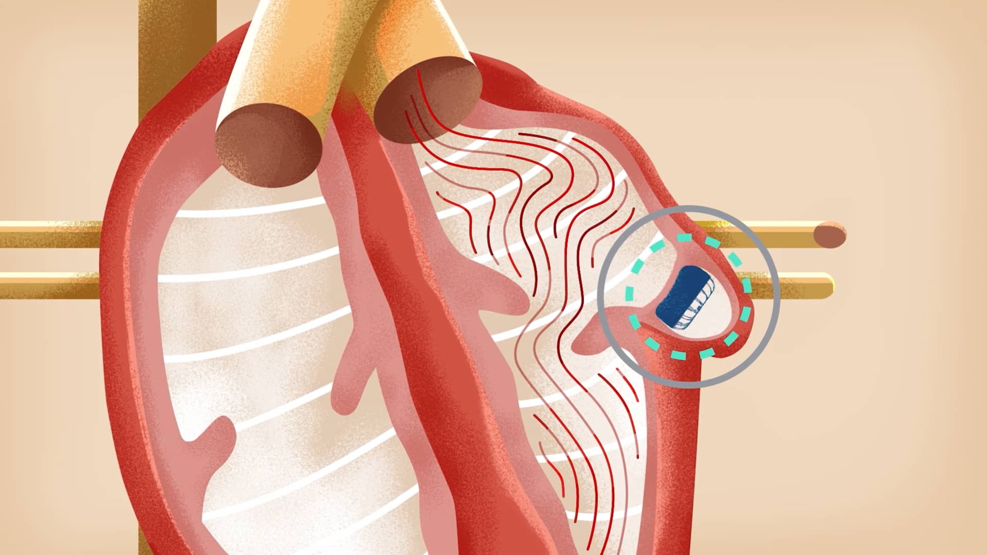How does the WATCHMAN Implant Work? on Vimeo