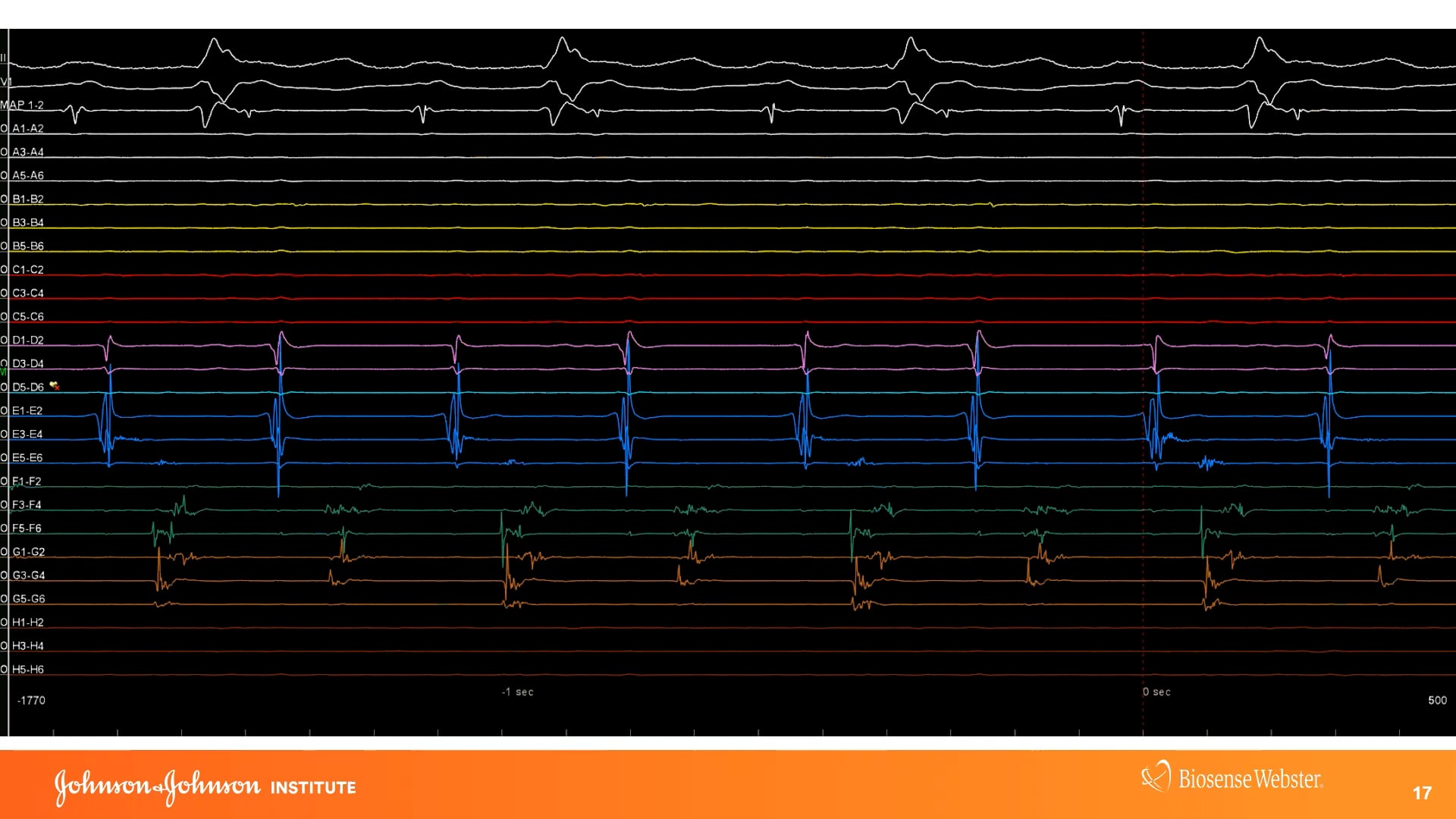 OCTARAY Mapping Catheter With TRUEref Technology - J&J -2022-09-06 on Vimeo