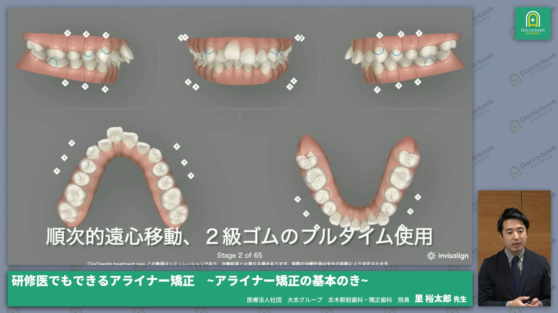 研修医でもできるアライナー矯正 アライナー矯正の基本のき