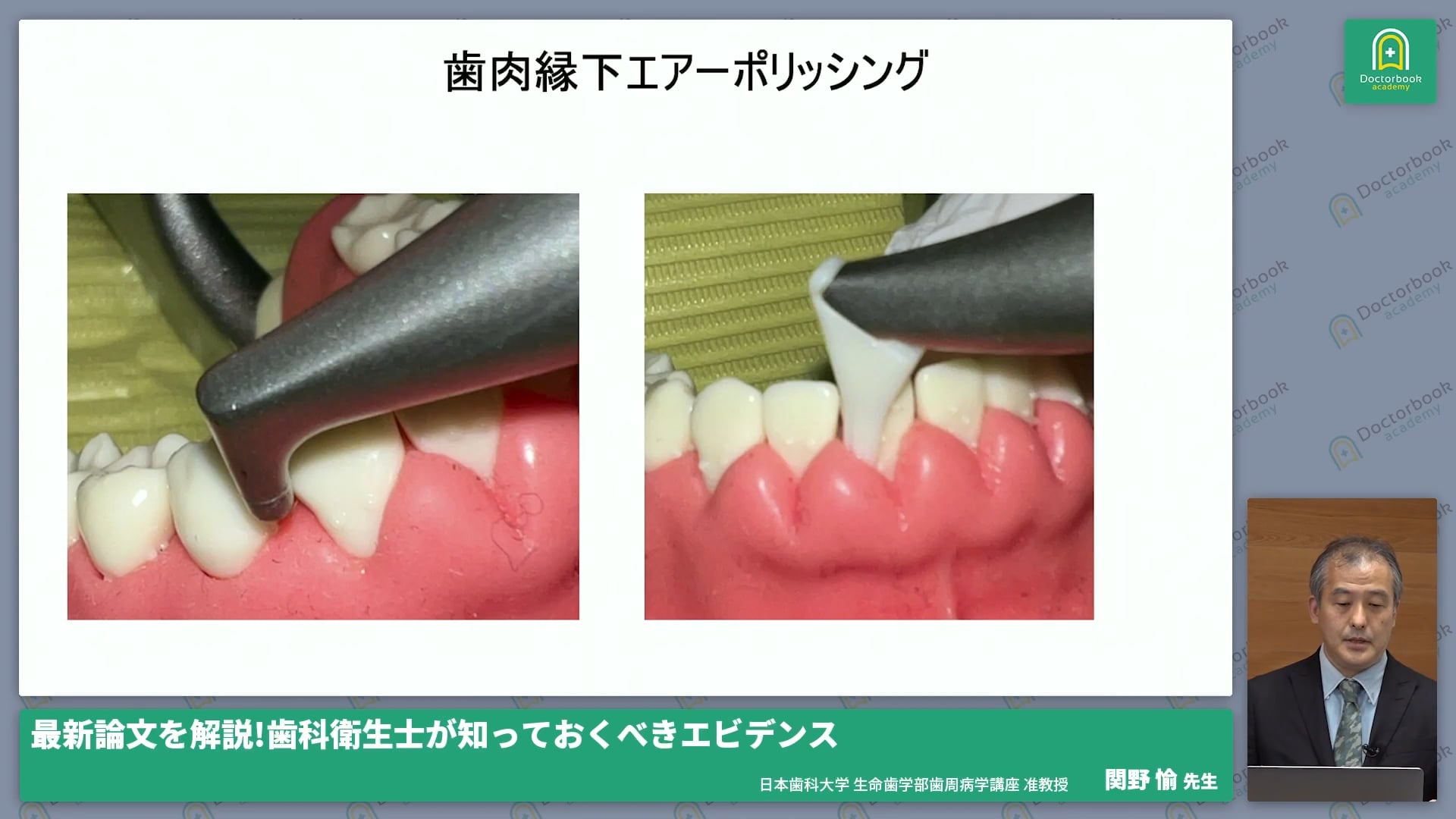 臨床知見録_予防_エアポリッシング