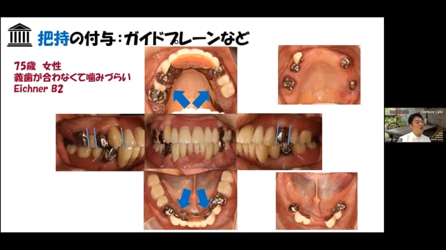 サベイドクラウン：その役割とは？│荻野 洋一郎先生 #1