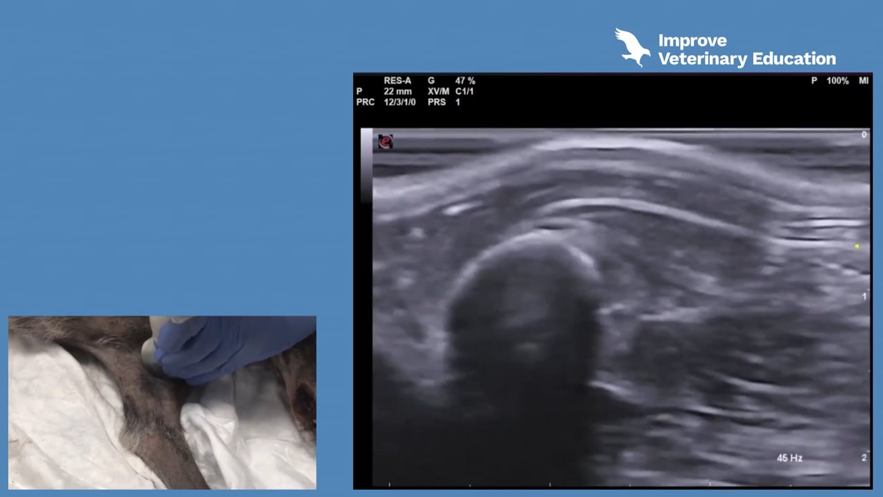 Ultrasound-guided RUMM block - Part 1 – musculocutaneous, median and ulnar nerves