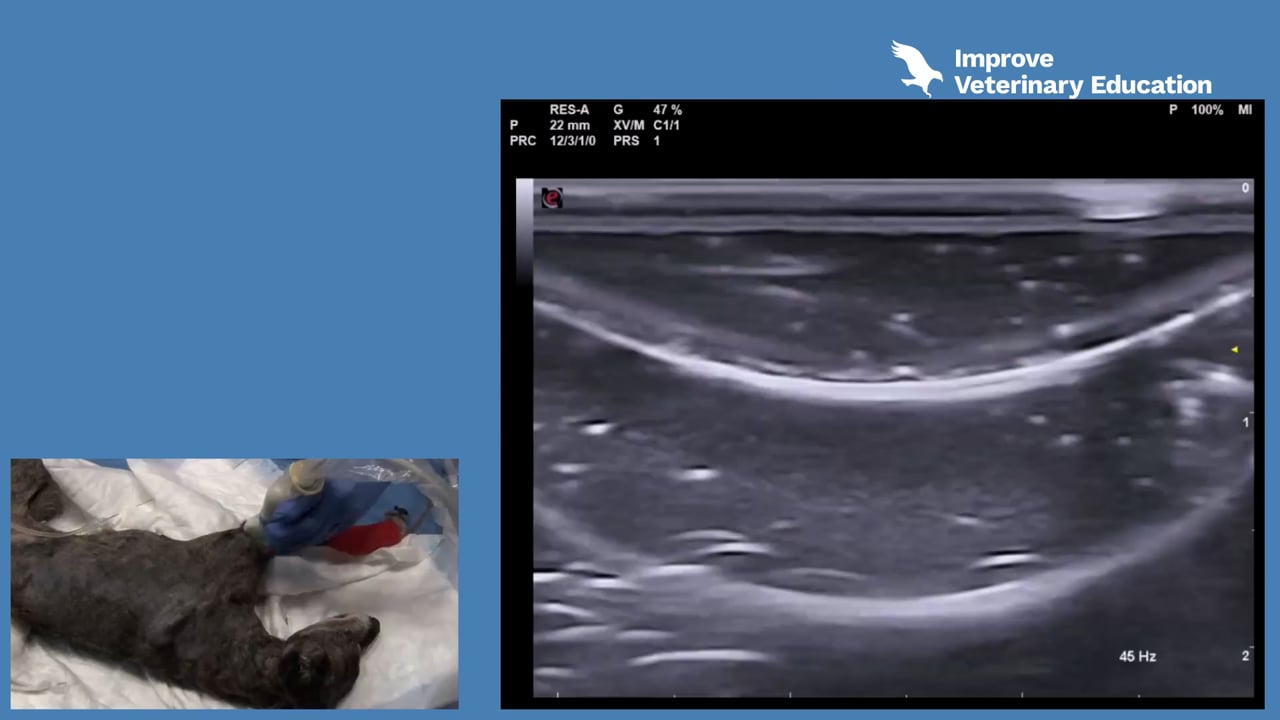 Ultrasound-guided RUMM block - Part 2 – radial nerve