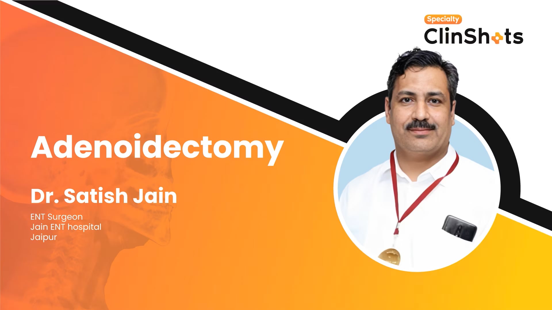 Adenoidectomy