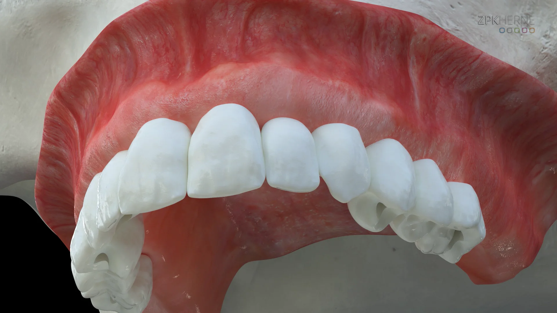 ProgressiveRidgeResorptionDueToRemovableProstheses