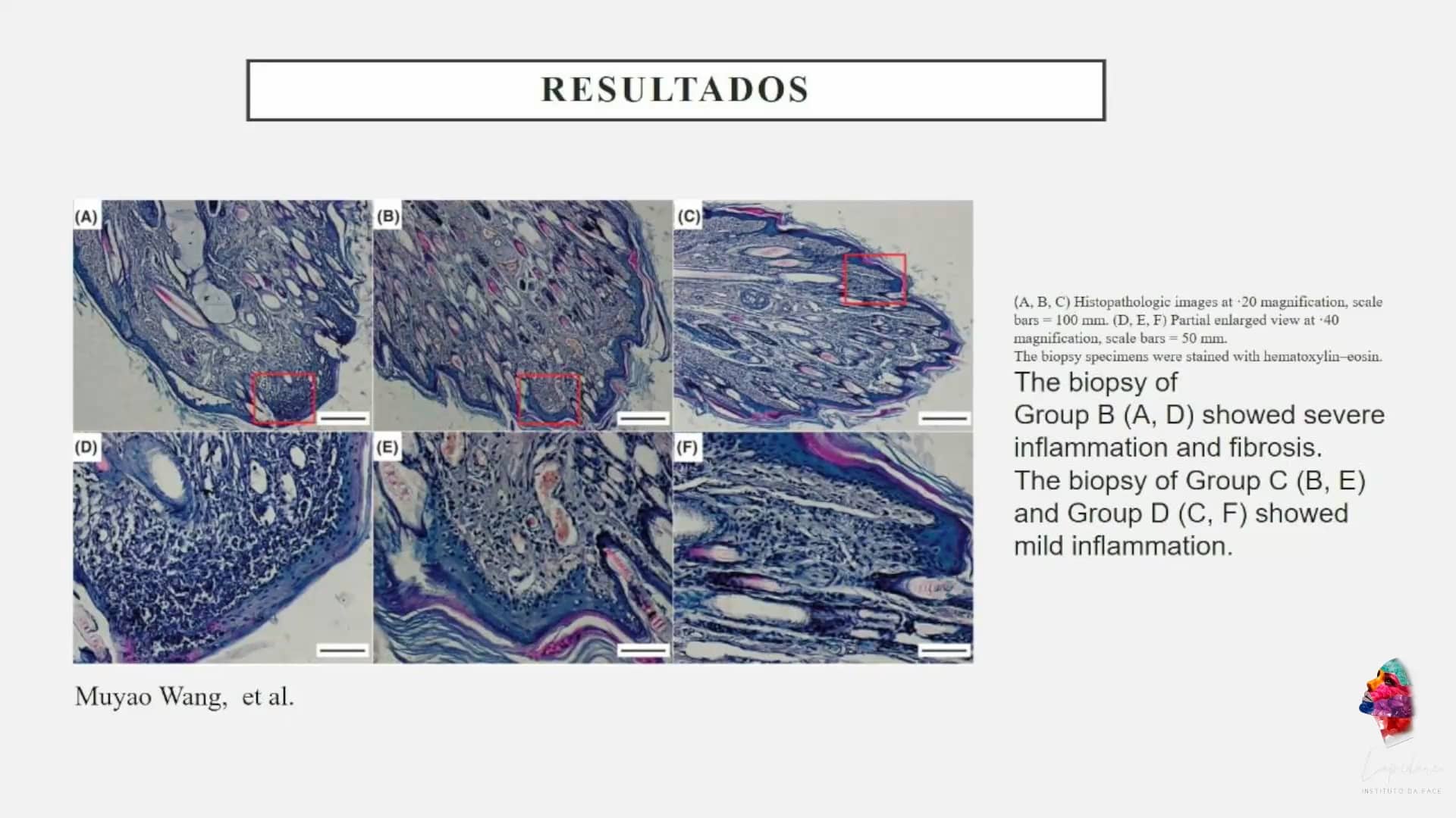 Complicações vasculares em procedimentos injetáveis da face com ácido ...