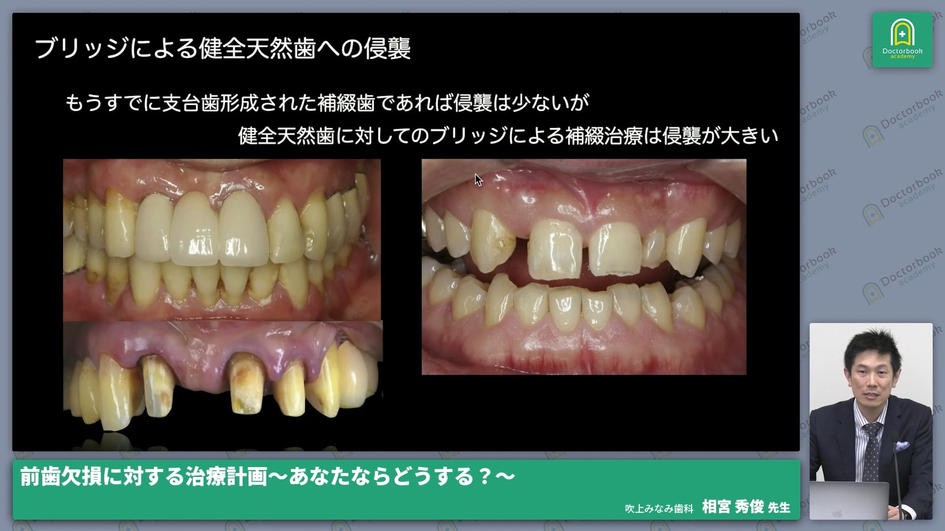 臨床知見録_欠損補綴選択_健康天然歯への場合の影響