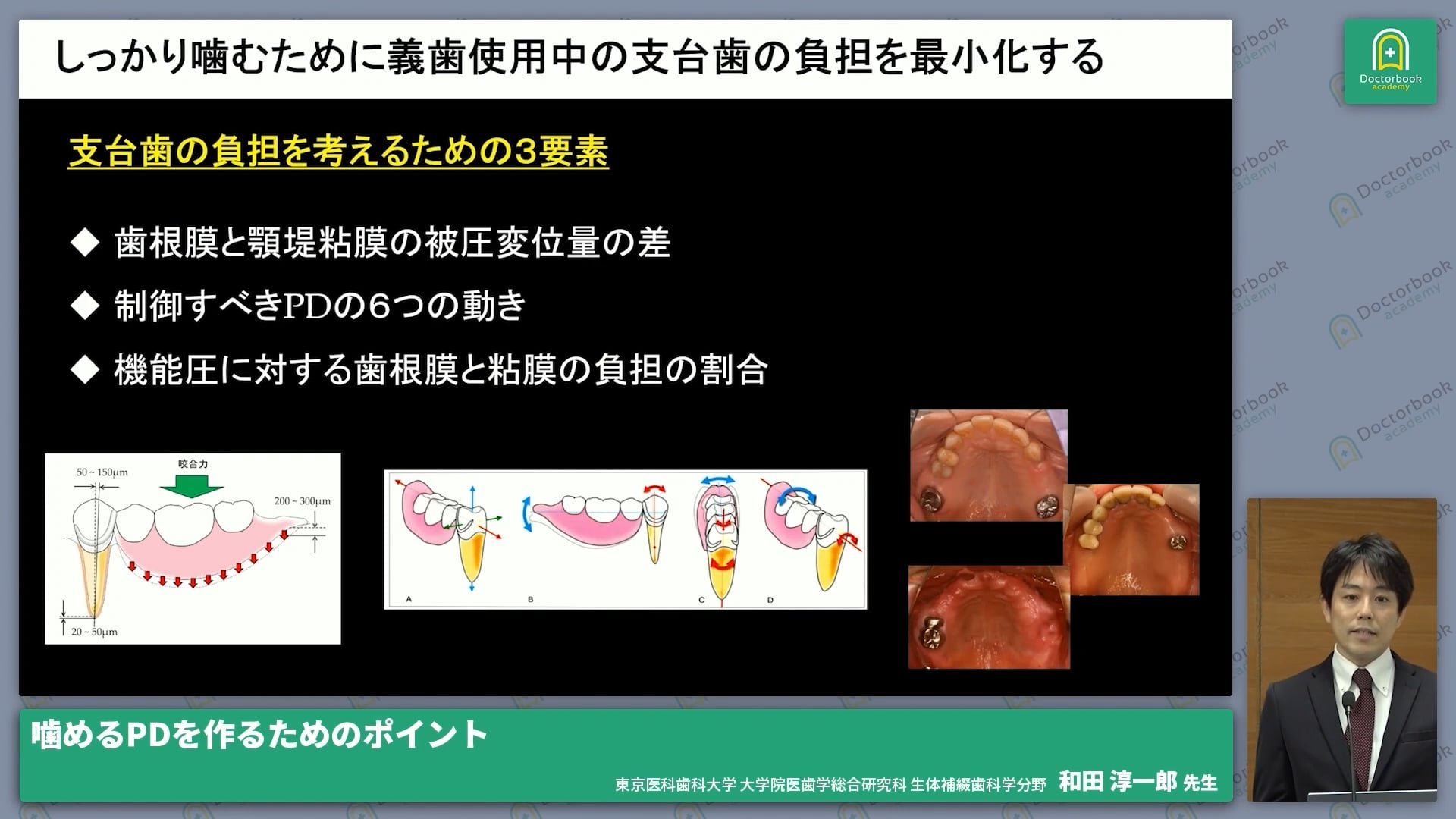 臨床知見録_欠損補綴選択_部分床義歯の設計におけるポイント