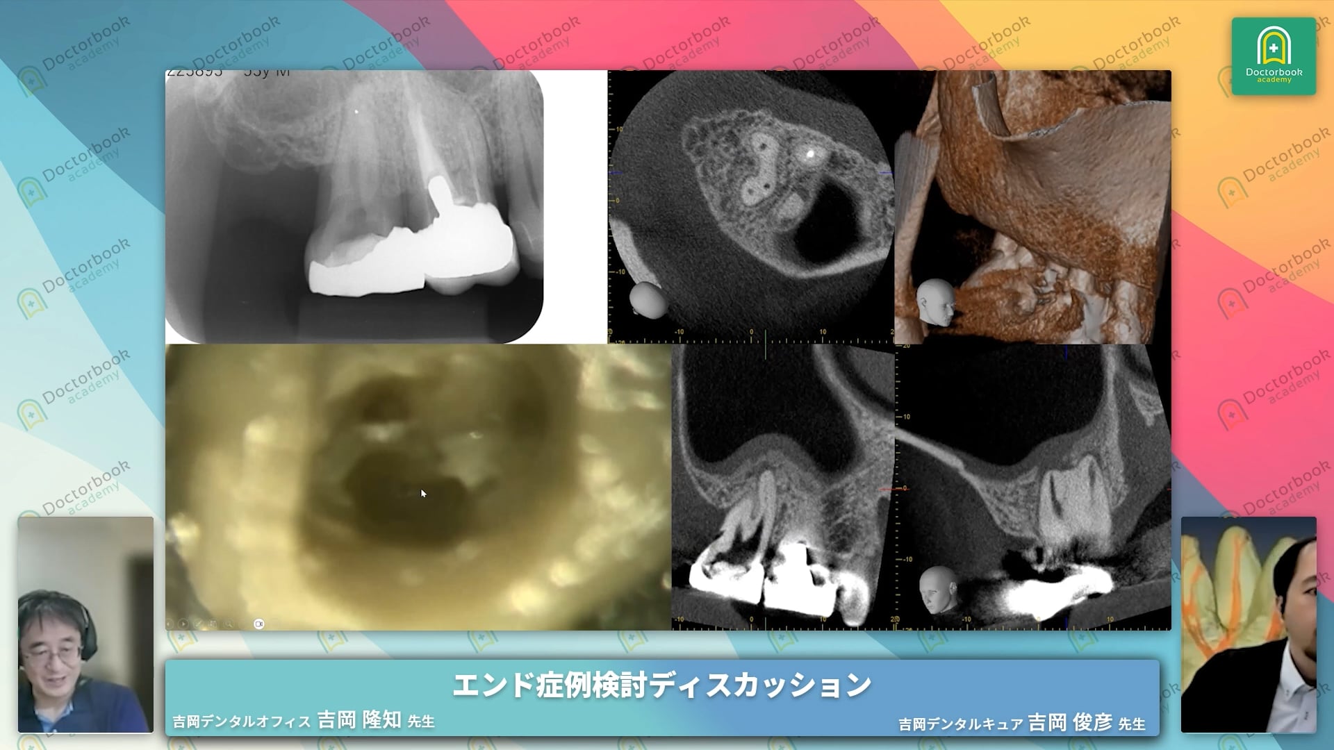 複数回治療症例│レジンコア築造まで3回・根充築造まで4回・根管形成が困難な症例