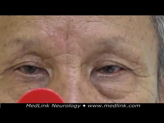 Downbeat nystagmus