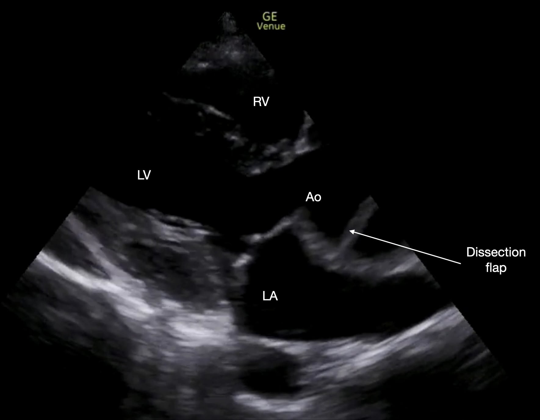 PLAx - Dilated Asc Ao and flap on Vimeo