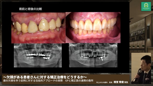 GP・かかりつけ医の立場から、歯の移植やインプラントを活用して咬合を考慮した矯正治療を行ったケース│相宮 秀俊先生