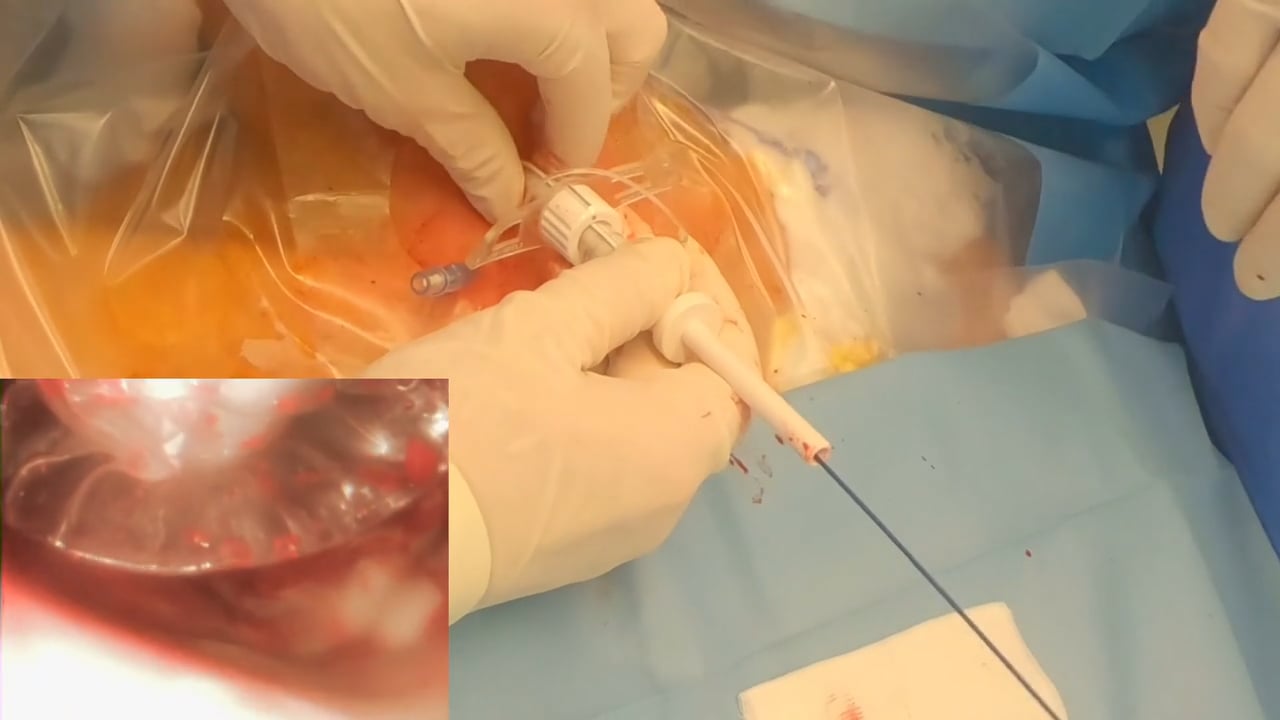 percutaneous tracheostomy procedure