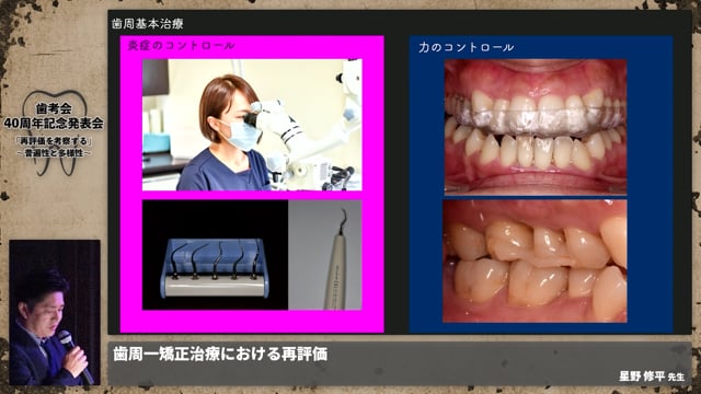 【ペリオ班】歯周ー矯正治療における再評価 │星野 修平先生