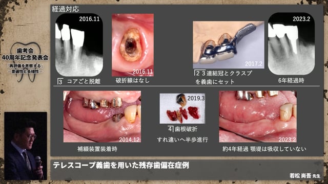 【補綴班】テレスコープ義歯を用いた残存歯偏在症例│若松 尚吾先生