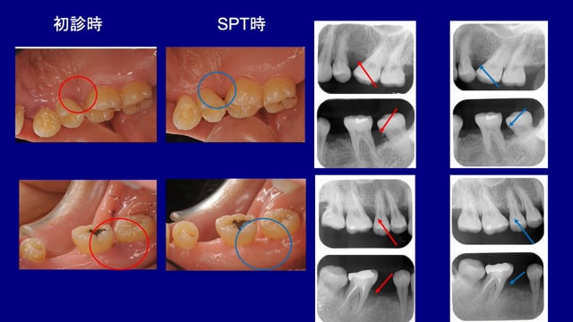 歯周組織再生治療の実際│歯の揺れと口臭が主訴の症例