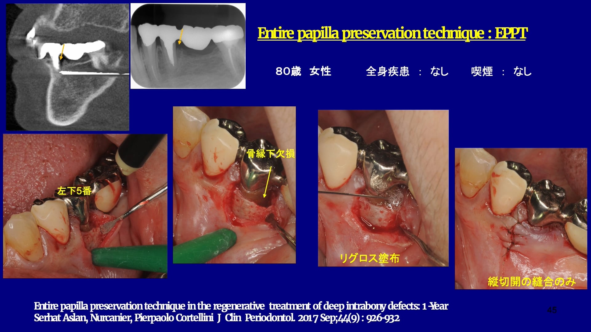 リグロス・エムドゲインを用いた歯周再生治療症例