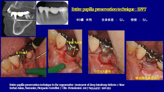 リグロス・エムドゲインを用いた歯周再生治療症例