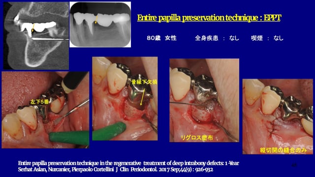 低侵襲な歯周組織再生治療(MIST)その具体的な施術法 | Doctorbook 