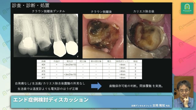 上顎右側第一大臼歯、歯髄保存判断に苦慮した1症例 #1
