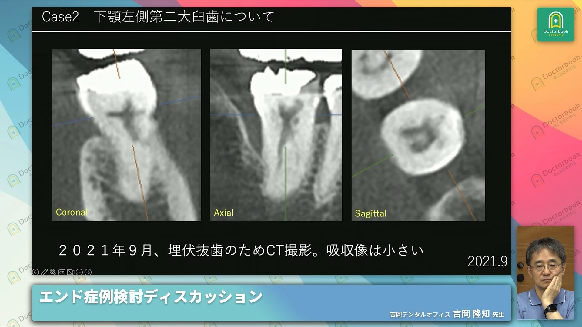 ICR（Invasive Cervical Root Resorption）：クラスⅡ侵襲性歯頚部歯根吸収症例 / クラスⅣ侵襲性歯頚部歯根吸収症例  #2