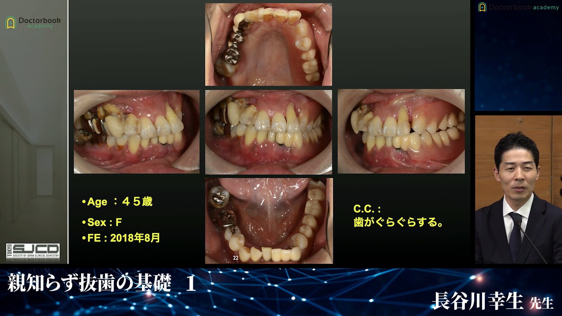 抜歯が行われなかったら│完全版！埋伏抜歯のバイブル 1