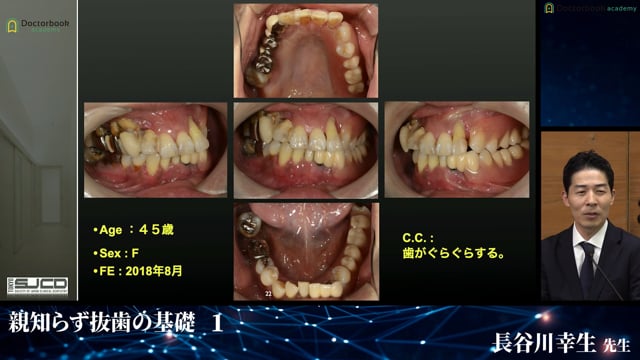 抜歯が行われなかったら│完全版！埋伏抜歯のバイブル 1