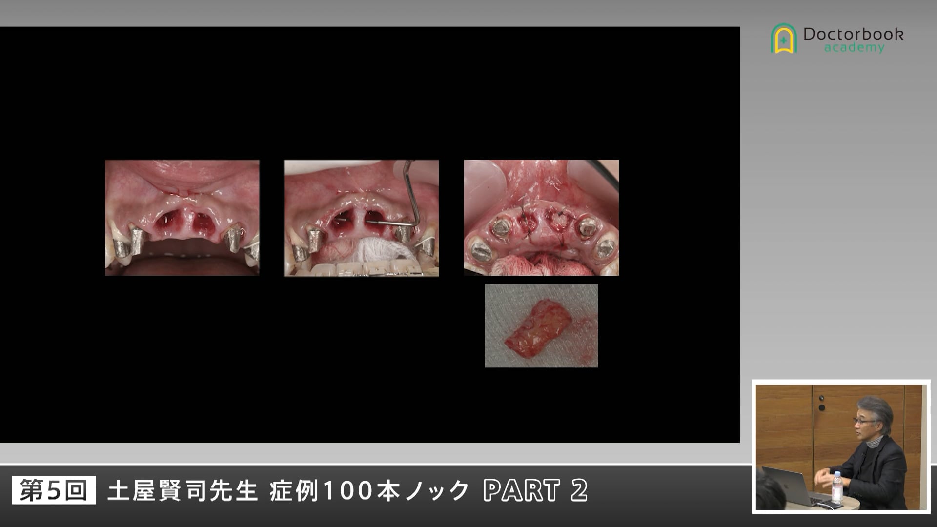 臨床知見録_プリザベーション_リカバリーケースについて