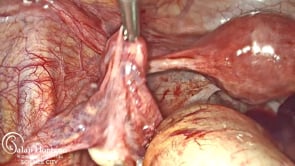 Laparoscopic Oophorectomy for Ovarian Torsion • Video •