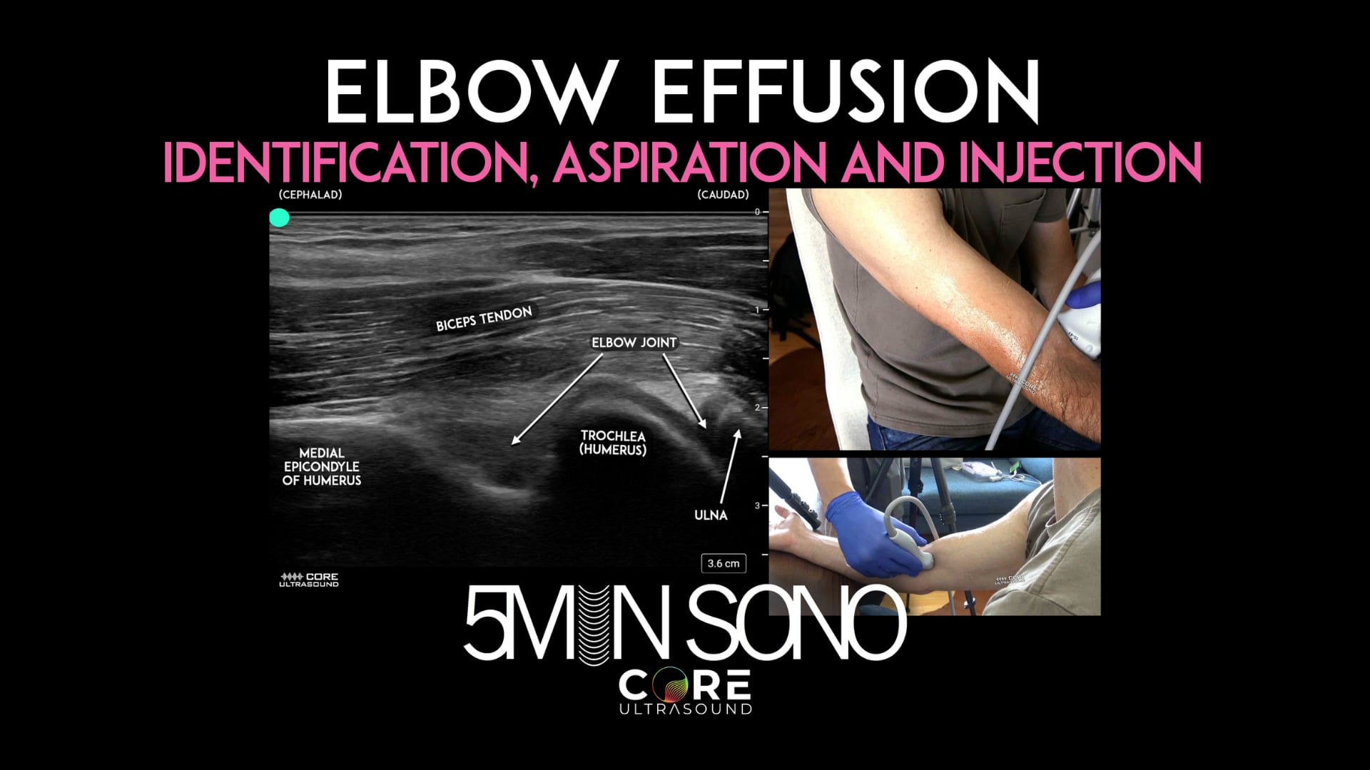 Image of Elbow Effusion – Identification, Aspiration, Injection (5MS)