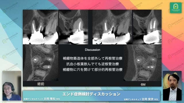 左上第一大臼歯連結前装冠の近心頬側根に病変を認めた症例