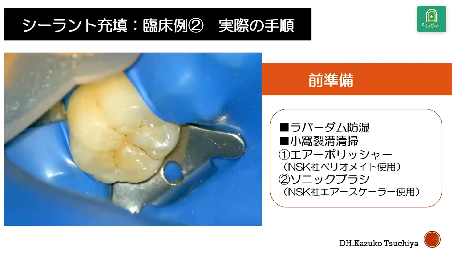 臨床知見録_初めてのマイクロスコープ_シーラントの診療