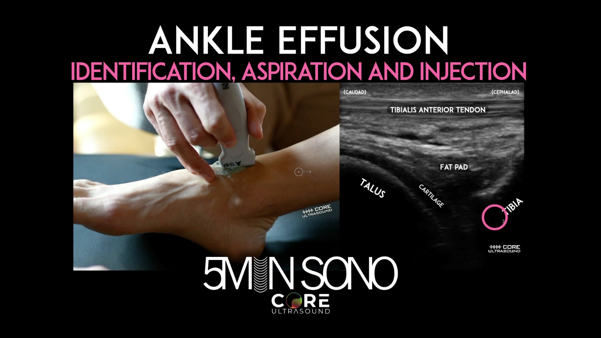 Image of Ankle Effusion – Identification, Aspiration, Injection (5MS)