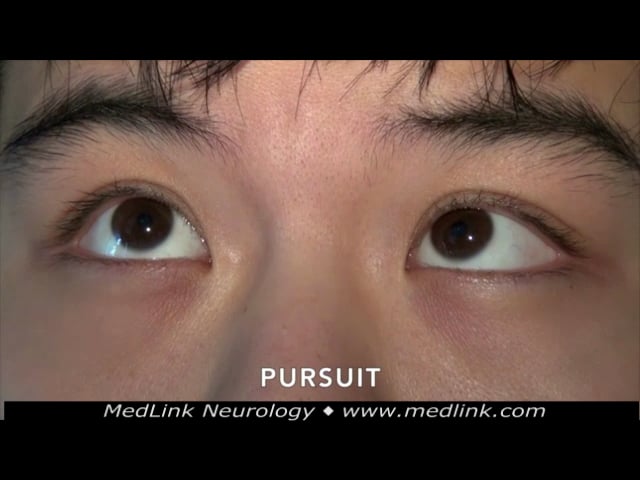 Nystagmus MedLink Neurology