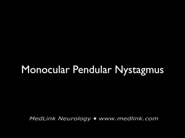 Downbeat nystagmus
