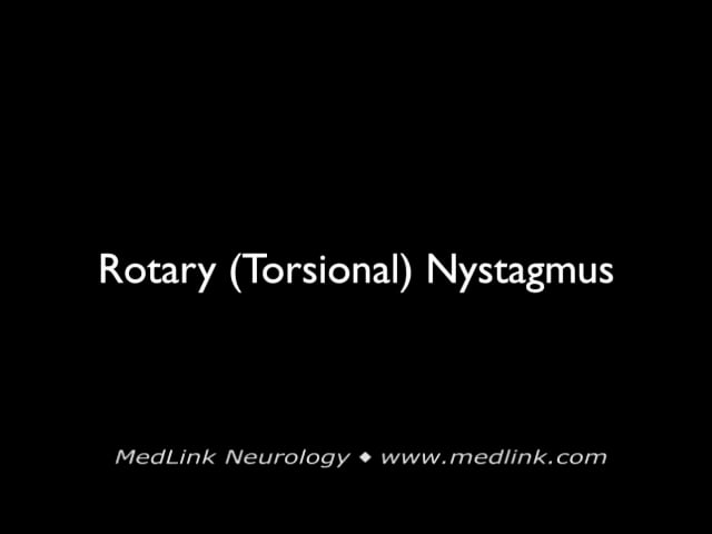 Rotary (torsional) nystagmus