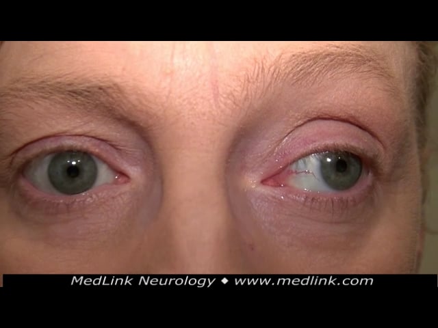 Downbeat nystagmus