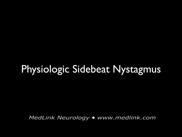 Downbeat nystagmus