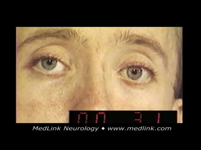 Ocular dysmetria