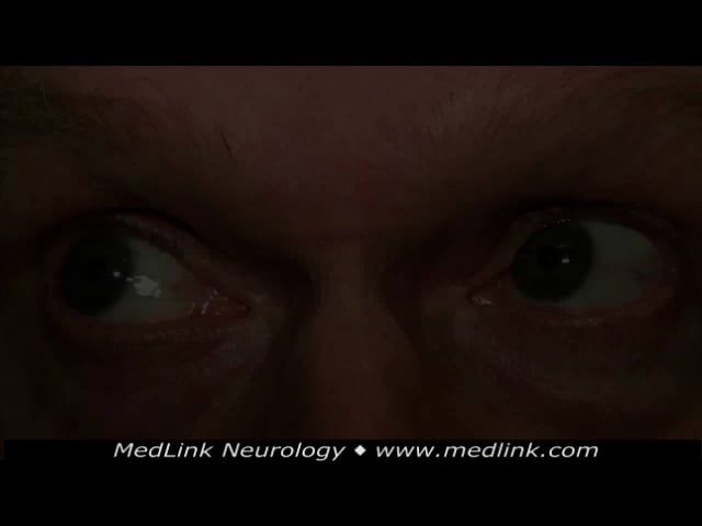Downbeat nystagmus