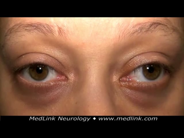 Ocular dysmetria