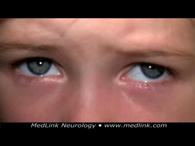 Downbeat nystagmus