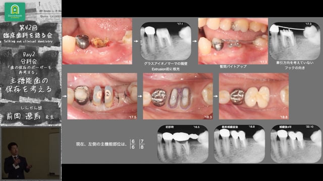 「主機能歯の保存を考える」臨床歯科を語る会 分科会 歯の保存のボーダーを再考する #1　前岡遼馬先生