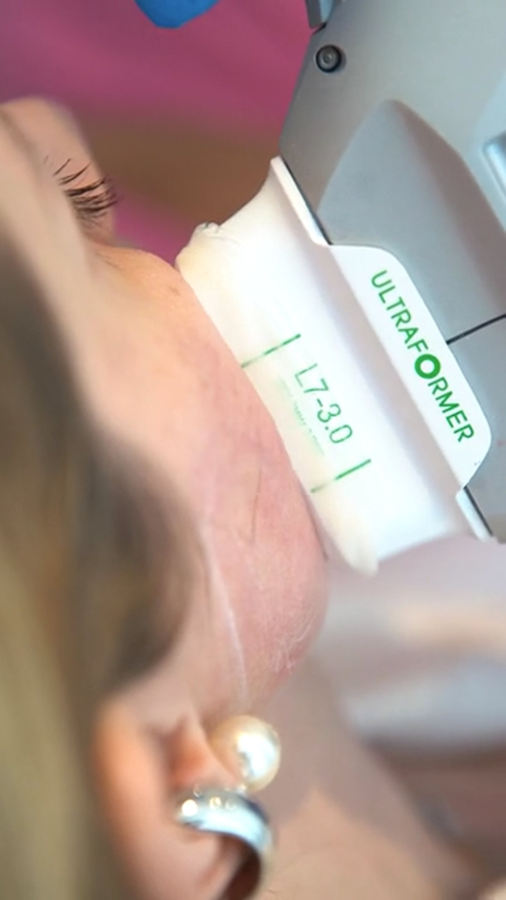 Clínica Odara - Ultraformer