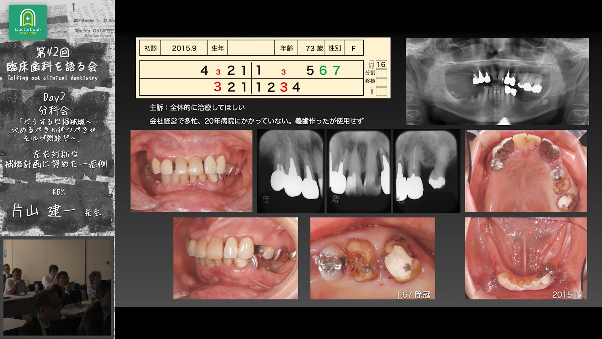 「左右対称な補綴設計に努めた一症例」臨床歯科を語る会 分科会 どうする欠損補綴～攻めるべきか待つべきか　それが問題だ～ #1　片山建一先生