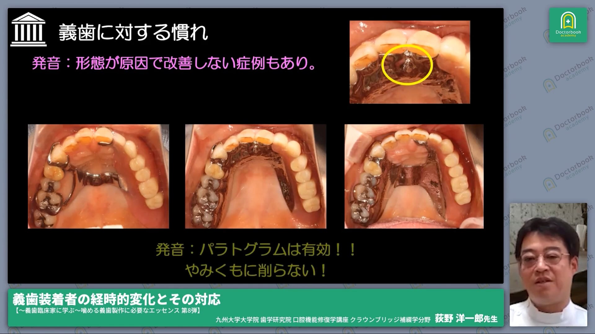 義歯装着者の経時的変化とその対応【〜義歯臨床家に学ぶ〜噛める義歯製作に必要なエッセンス 第8弾】