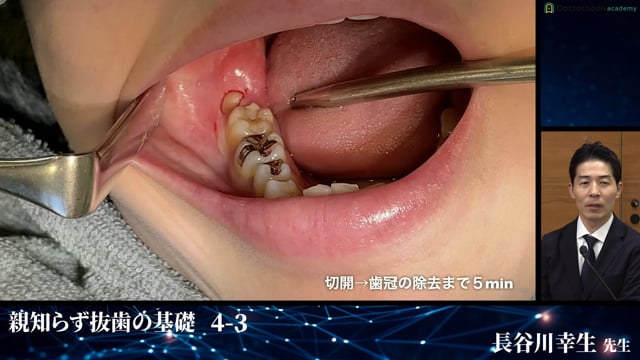 下顎枝に大部分が埋まっている症例│親知らず抜歯の基礎 4-3