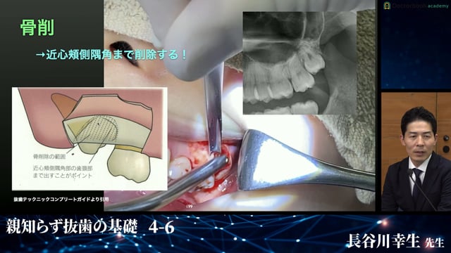 上顎埋伏智歯の症例│親知らず抜歯の基礎 4-6
