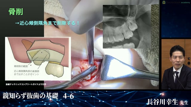 上顎埋伏智歯の症例│親知らず抜歯の基礎 4-6