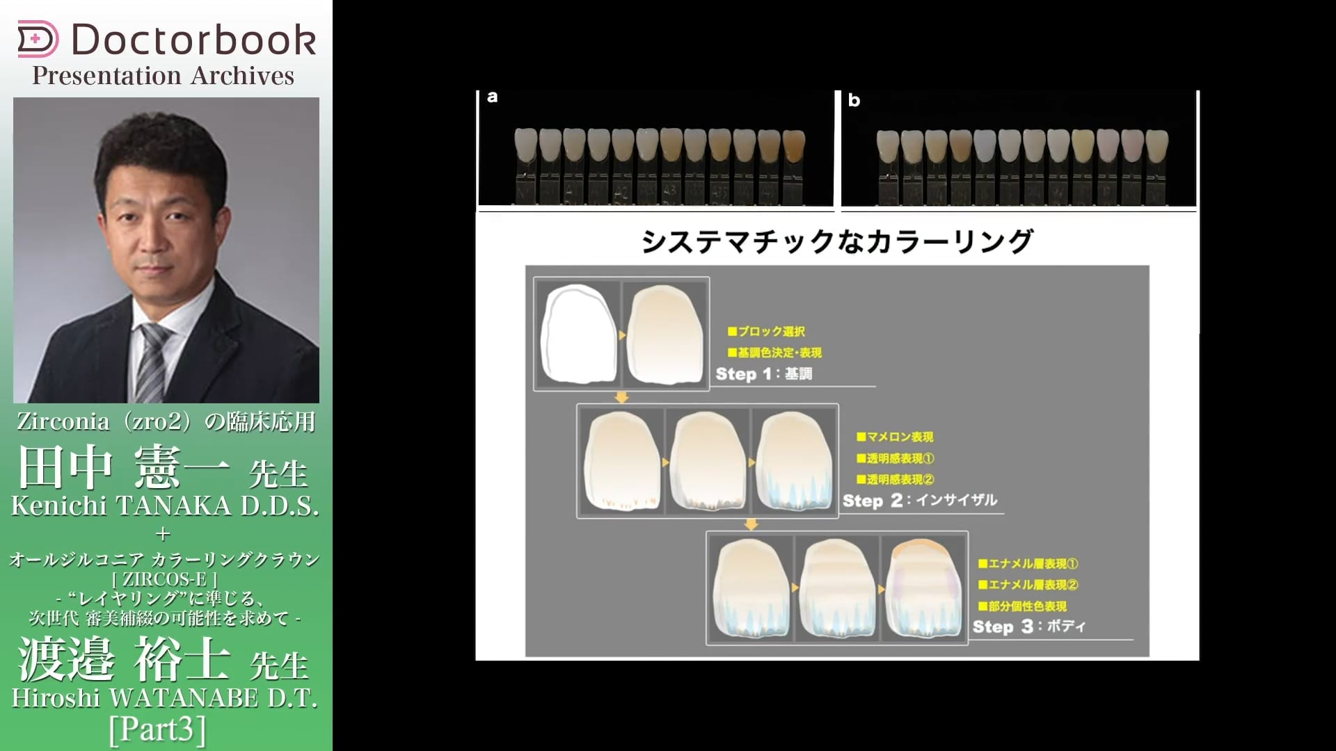 臨床知見録_審美補綴_シェードの選び方